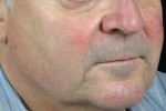 Laser Skin Resurfacing Before and after photo