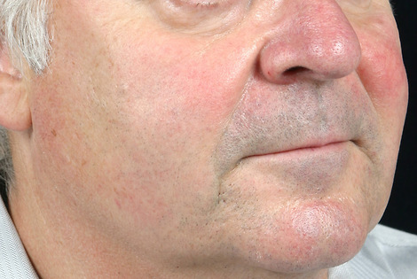 Laser Skin Resurfacing before and after photo