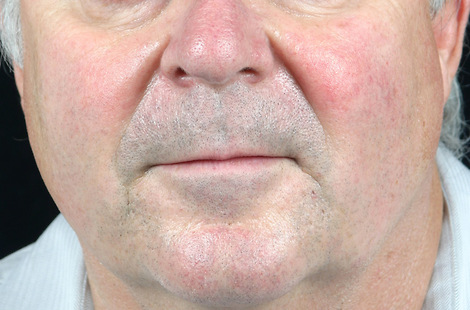 Laser Skin Resurfacing before and after photo