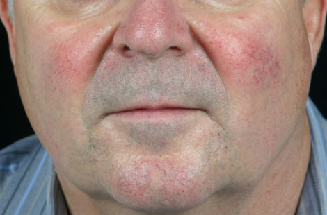 Laser Skin Resurfacing before and after photo