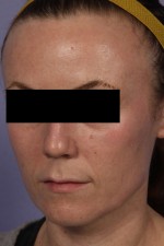 Laser Skin Resurfacing Before and after photo