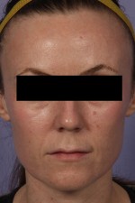 Laser Skin Resurfacing Before and after photo