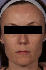 Laser Skin Resurfacing Before and after photo