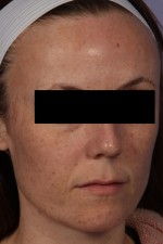 Laser Skin Resurfacing Before and after photo