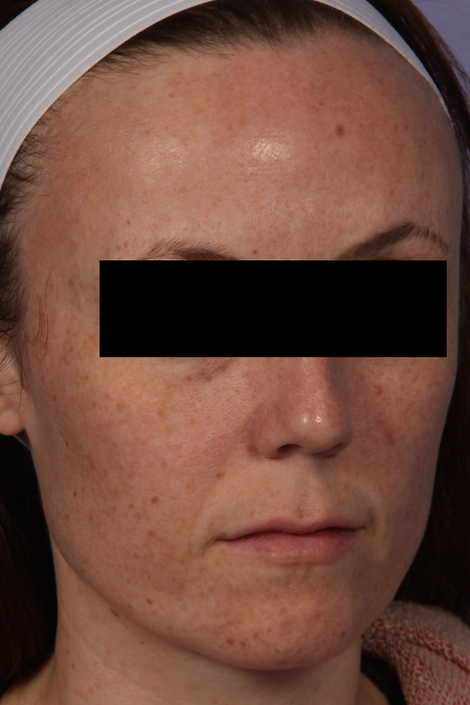 Laser Skin Resurfacing before and after photo