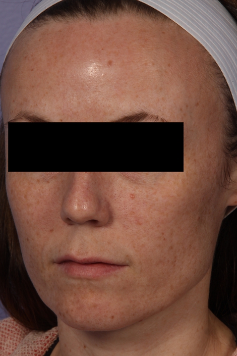 Laser Skin Resurfacing before and after photo