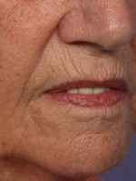 Laser Skin Resurfacing Before and after photo