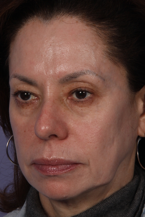 Laser Skin Resurfacing before and after photo