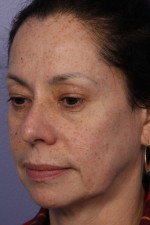 Laser Skin Resurfacing Before and after photo