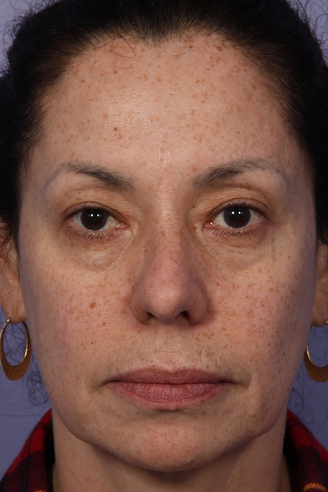 Laser Skin Resurfacing before and after photo