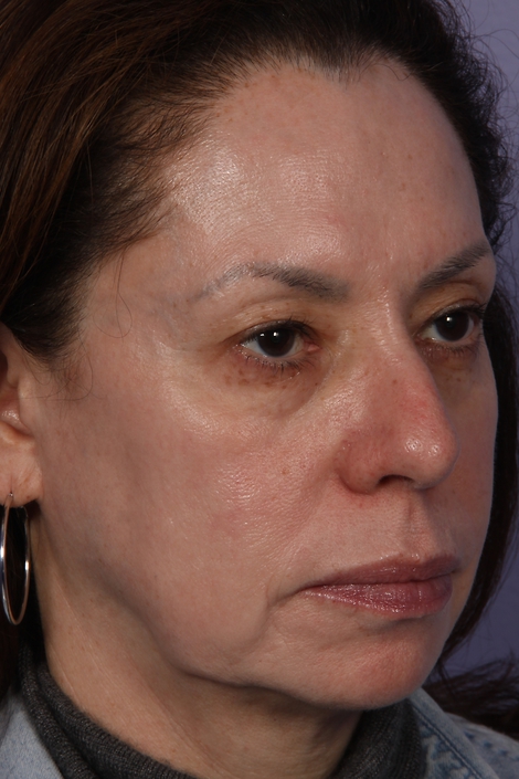 Laser Skin Resurfacing before and after photo