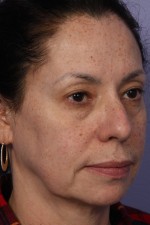 Laser Skin Resurfacing Before and after photo