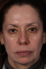 Laser Skin Resurfacing Before and after photo