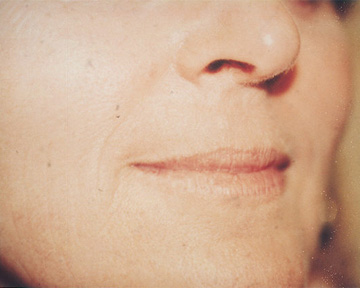 Laser Skin Resurfacing before and after photo