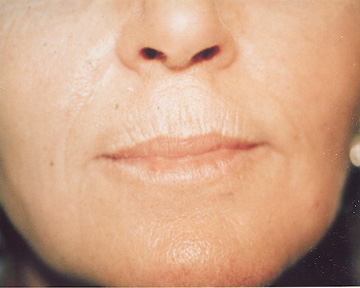 Laser Skin Resurfacing before and after photo