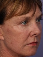 Laser Skin Resurfacing Before and after photo