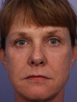 Laser Skin Resurfacing Before and after photo