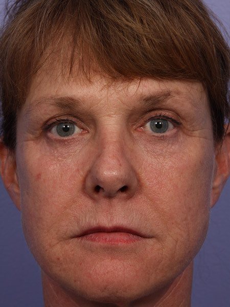 Laser Skin Resurfacing before and after photo