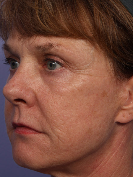 Laser Skin Resurfacing before and after photo