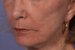 Laser Skin Resurfacing Before and after photo