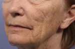 Laser Skin Resurfacing Before and after photo