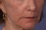 Laser Skin Resurfacing Before and after photo