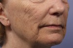 Laser Skin Resurfacing Before and after photo