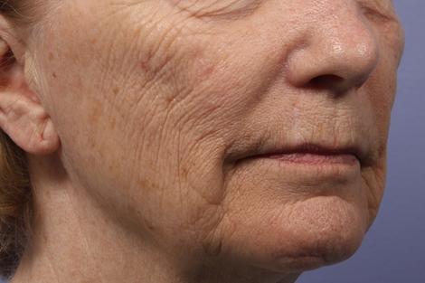 Laser Skin Resurfacing before and after photo