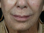 Laser Skin Resurfacing Before and after photo