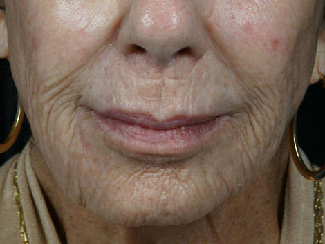 Laser Skin Resurfacing before and after photo