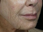 Laser Skin Resurfacing Before and after photo