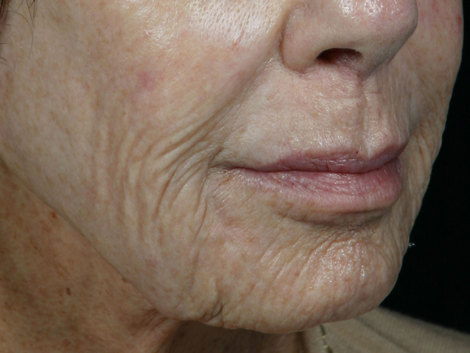 Laser Skin Resurfacing before and after photo