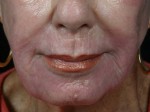 Laser Skin Resurfacing Before and after photo