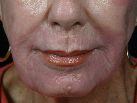 Laser Skin Resurfacing before and after photo