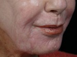 Laser Skin Resurfacing Before and after photo