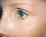 Laser Skin Resurfacing Before and after photo