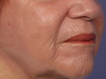 Laser Skin Resurfacing