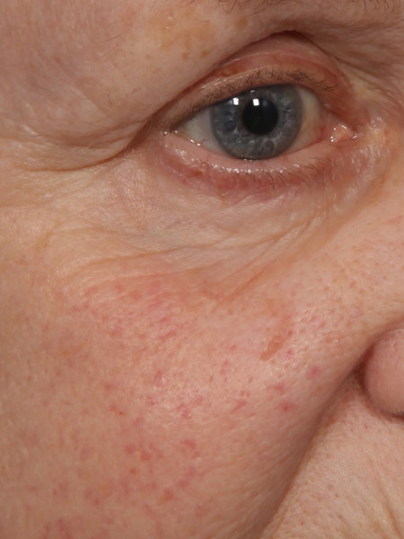 Laser Skin Resurfacing before and after photo