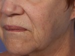 Laser Skin Resurfacing Before and after photo