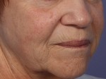 Laser Skin Resurfacing Before and after photo