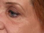 Laser Skin Resurfacing Before and after photo