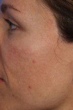 Laser Skin Resurfacing