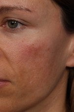 Laser Skin Resurfacing Before and after photo