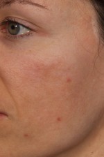 Laser Skin Resurfacing Before and after photo