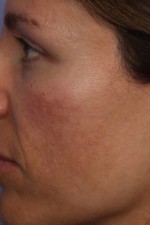 Laser Skin Resurfacing Before and after photo