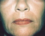 Laser Skin Resurfacing