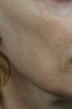 Laser Skin Resurfacing Before and after photo