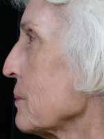 Laser Skin Resurfacing Before and after photo