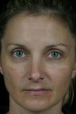 Laser Skin Resurfacing Before and after photo