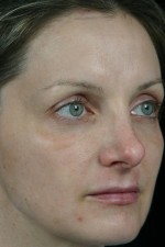 Laser Skin Resurfacing